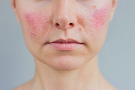 Health Conditions Indicated by a Red Face After Drinking Wine