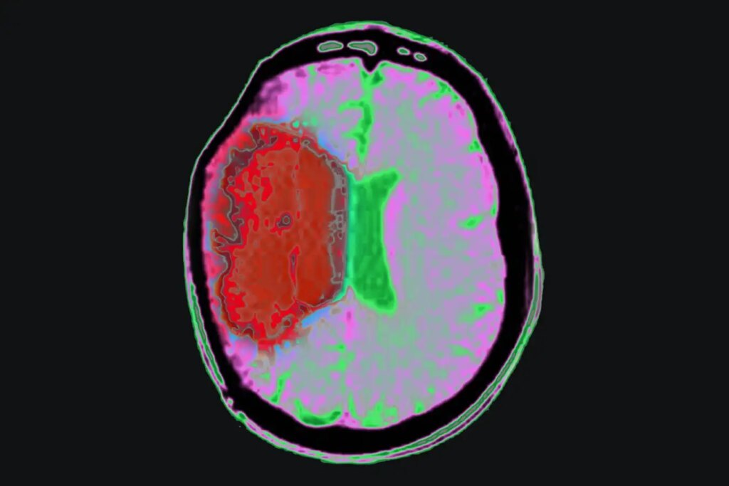 How Cooling Therapy with Medications Can Minimize Brain Damage After