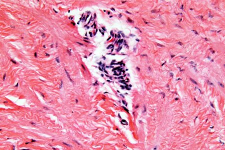 How Endometriosis Impacts Areas Beyond the Pelvis After Surgical Removal