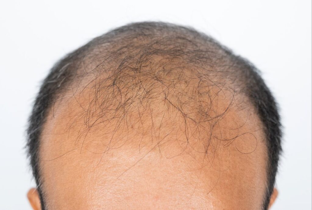 Top 5 Effective Strategies to Combat Hair Loss Explained by