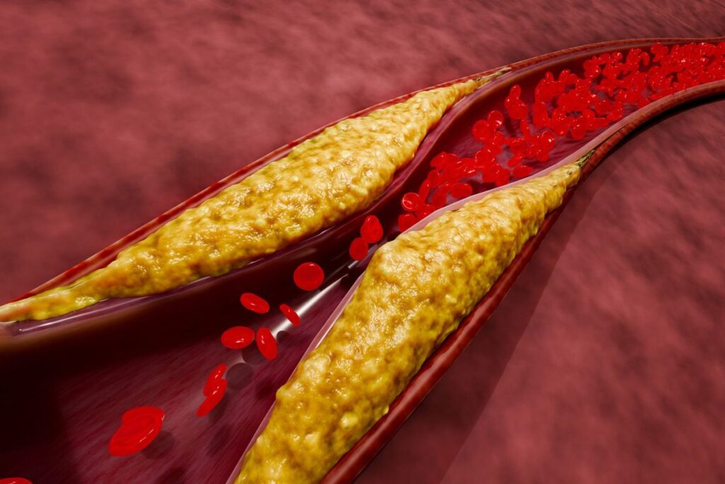 Exciting Milestone: Breakthrough Treatment achieves 62% cholesterol reduction with single dose Exciting Milestone Breakthrough Treatment achieves 62 cholesterol reduction with single