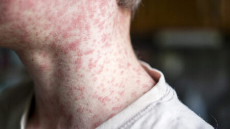 18-year-old dies from measles in Pennsylvania, with severe neurological complications 18 year old dies from measles in Pennsylvania with severe neurological complications
