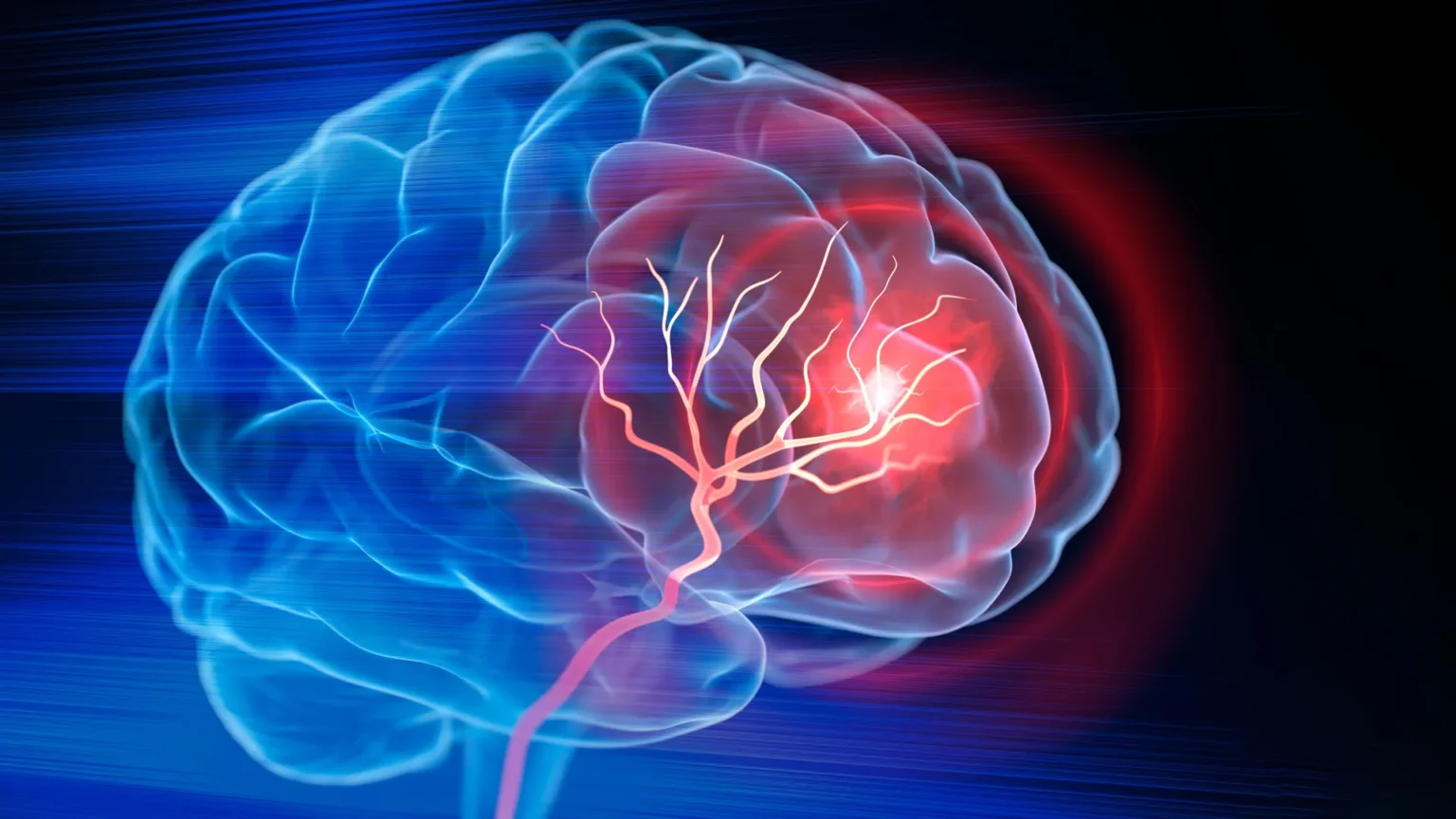 New Injection Treatment Helps Rebuild Brain After Stroke
