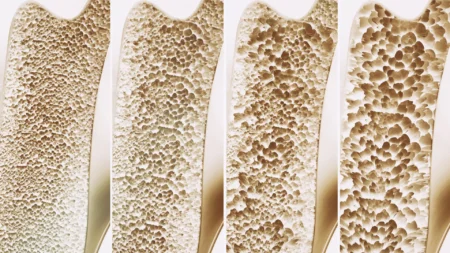 Scientists discover bone formation switch to fight osteoporosis