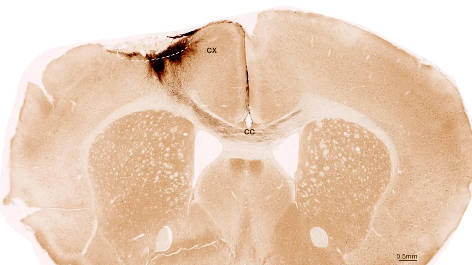 Stem cells reverse stroke injury and restore movement in mice