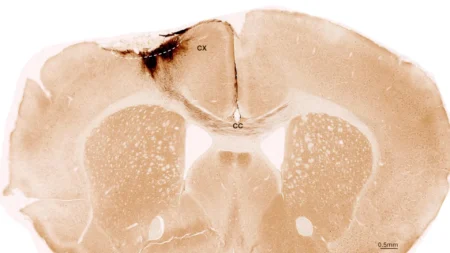 Stem cells reverse stroke injury and restore movement in mice