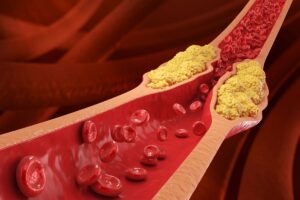 The Top Method Recommended by Doctors to Lower Cholesterol Naturally Without Statins The Top Method Recommended by Doctors to Lower Cholesterol Naturally