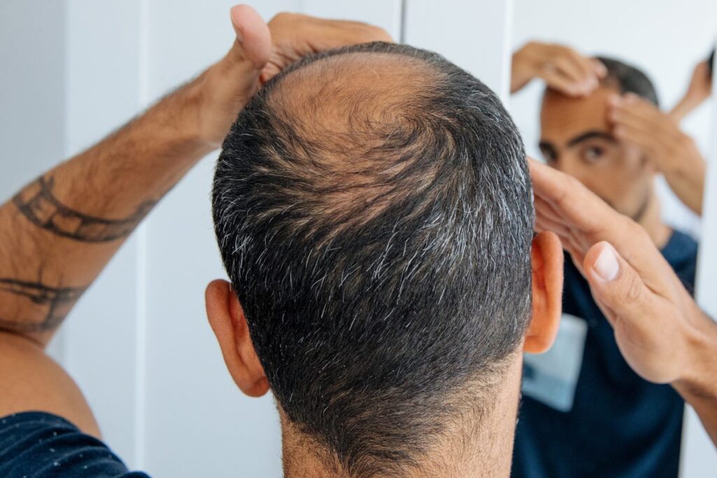 Understanding Your Health Status from Your Hairline The Significance of