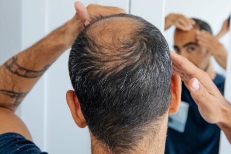 Understanding Your Health Status from Your Hairline The Significance of