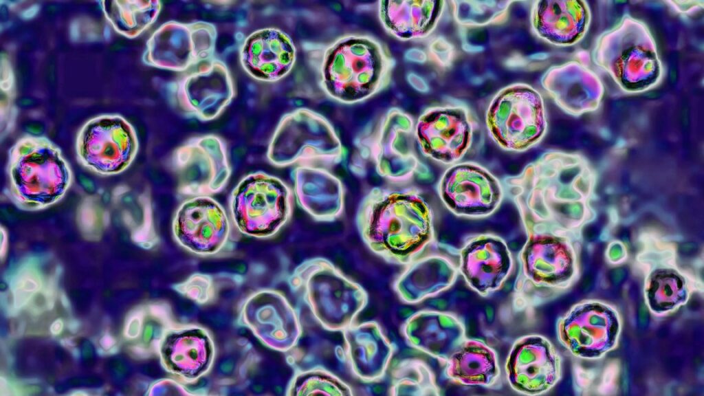Unvaccinated Pennsylvania woman dies from measles complications coroner says