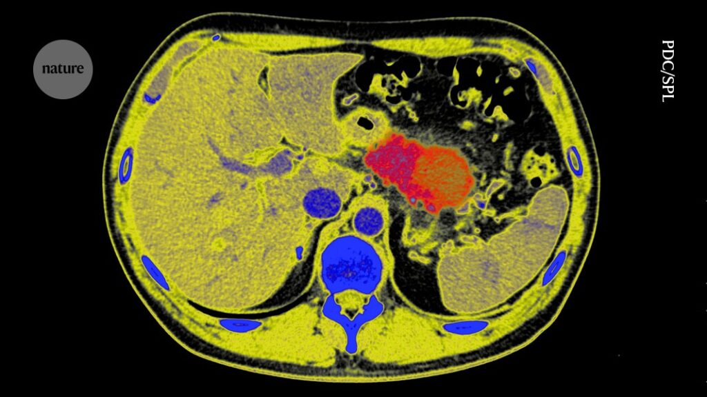 Can Pancreatic Cancer Progression be Stopped Radical Tactics Raise Expectations