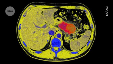 Can Pancreatic Cancer Progression be Stopped? Radical Tactics Raise Expectations Can Pancreatic Cancer Progression be Stopped Radical Tactics Raise Expectations