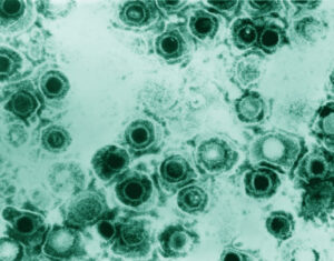 Cold Sore Virus Leaves Lasting Traces in Brain Immune Cells