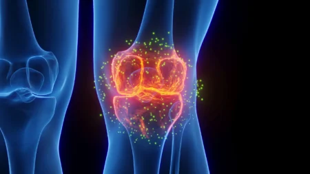 FDA approved epilepsy drug may help reverse osteoarthritis damage