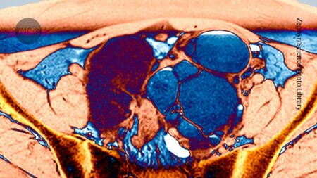 Impact of Endometriosis Drug on 190 Million People Early Promising
