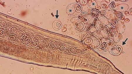 Insects Mate Inside a Human Eye as Larvae Are Removed Before They Emerge Insects Mate Inside a Human Eye as Larvae Are Removed