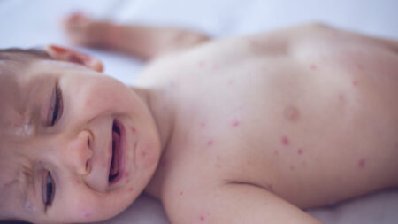 Pennsylvania Issues Warning About Congenital Measles Something That Hasnt