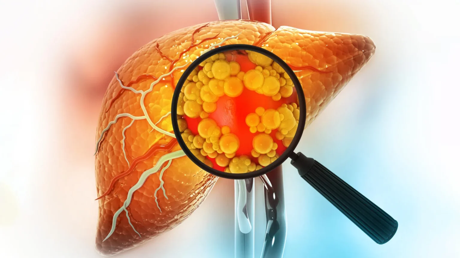 Scientists Discover Fatty Liver Disease is Actually Five Different Conditions