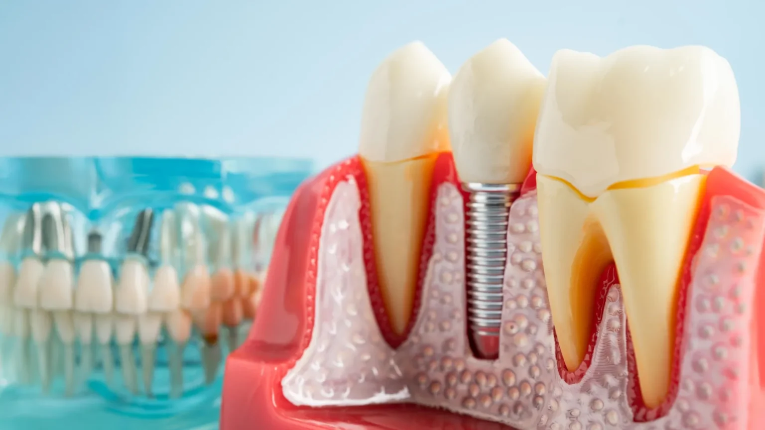 Scientists discover dental implants can affect your immune system