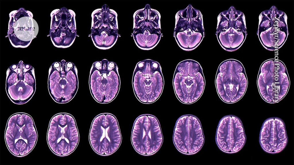 Teenage Depression and Anxiety Predicted by Childhood Brain Development