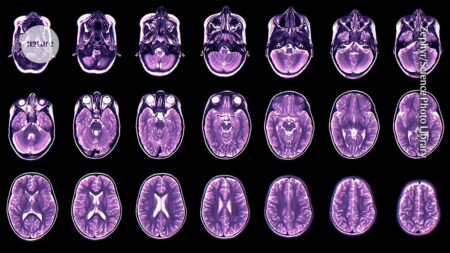 Teenage Depression and Anxiety Predicted by Childhood Brain Development
