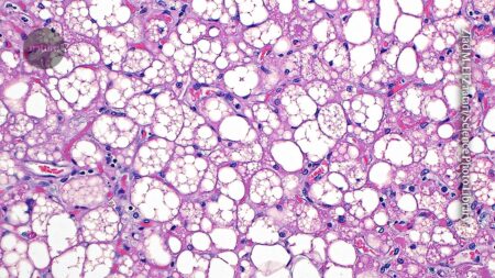 overlooked brown fat in bodies linked to health benefits